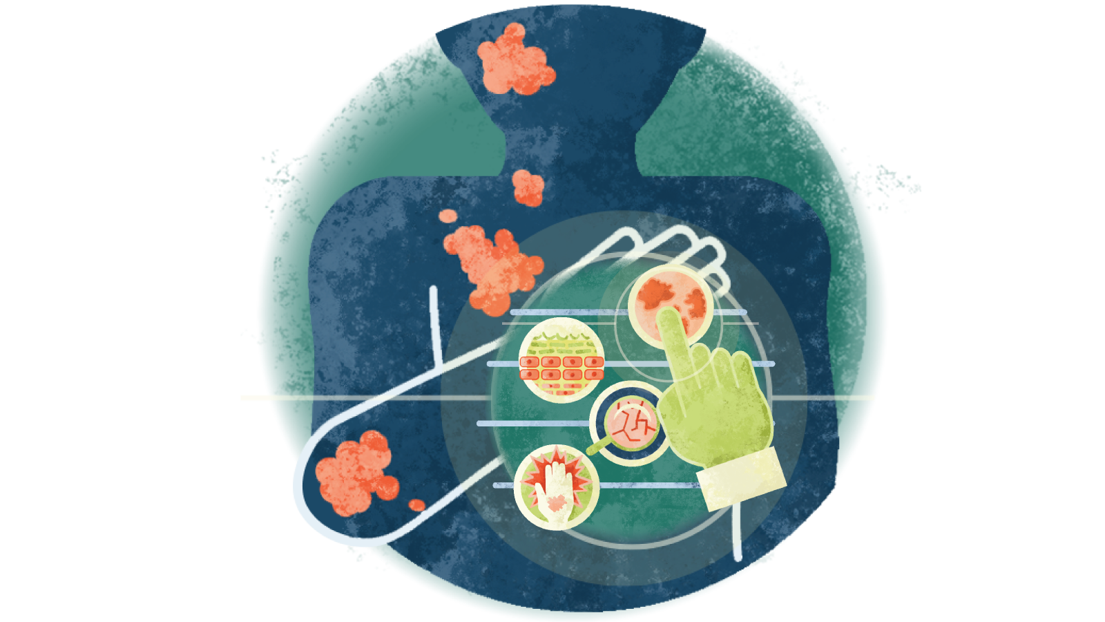 Illustration of four circles with atopic dermatitis over an arm with atopic dermatitis falling down onto the arm